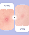 Original Hydrocolloid Patches - The Local Space