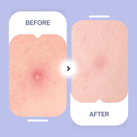 Original Hydrocolloid Patches - The Local Space